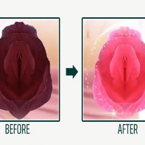 Cách trị thâm vùng kín lành tính, giúp cô bé hồng hào khó cưỡng